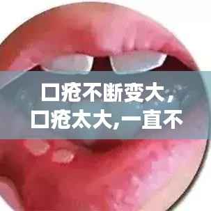 口疮不断变大,口疮太大,一直不好