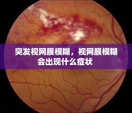 突发视网膜模糊,视网膜模糊会出现什么症状